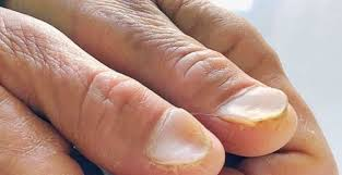 nail health